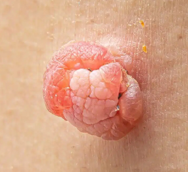 Anal Skin Tags & Hemorrhoid Removal